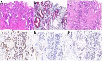 Intrahepatic cholangiocarcinoma detected on 18F-PSMA-1007 PET/MR imaging in a prostate cancer patient: a case report and literature review